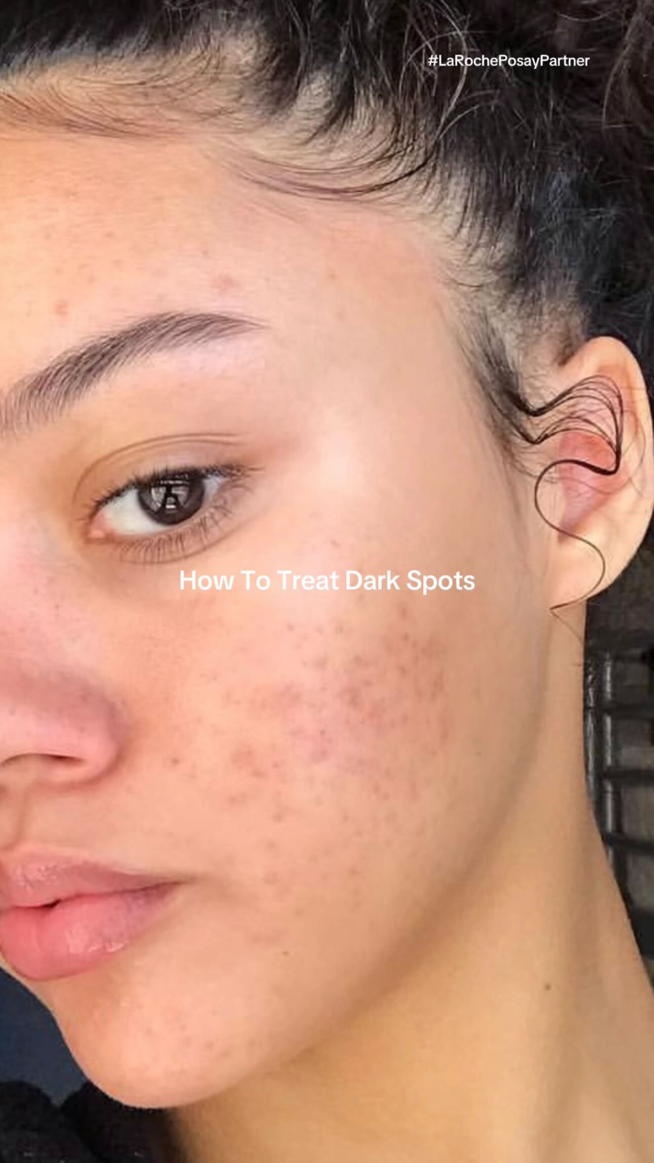 Instagram post by @diaryoftroubledskin for LaRochePosayUS. Caption reads: #LaRochePosayPartner Not every spot is acne 👀....
