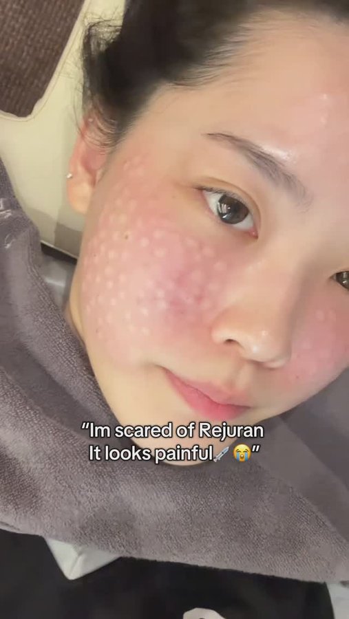Instagram post by @caspertheghostyyyy for Rejuran. Caption reads: Literally every hot girls are getting Rejuran🐟....