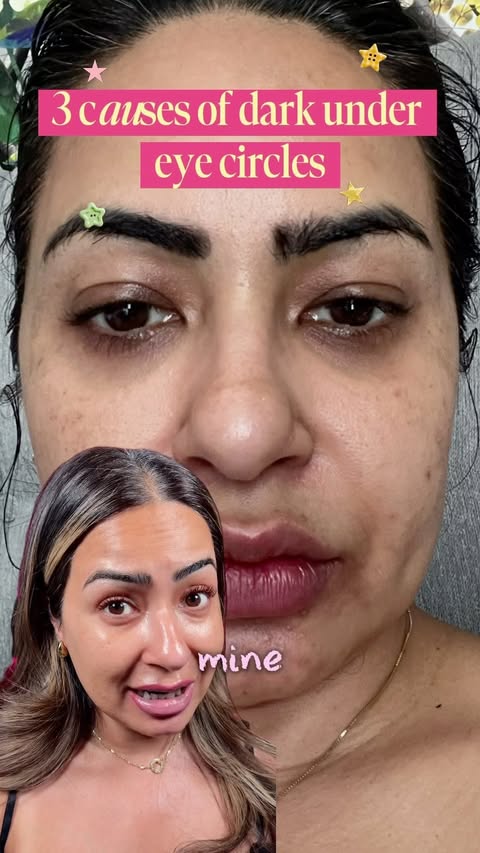 Instagram post by @zenia.chopra for Abib Cosmetics. Caption reads: Causes of dark under eye circles: pigment,....
