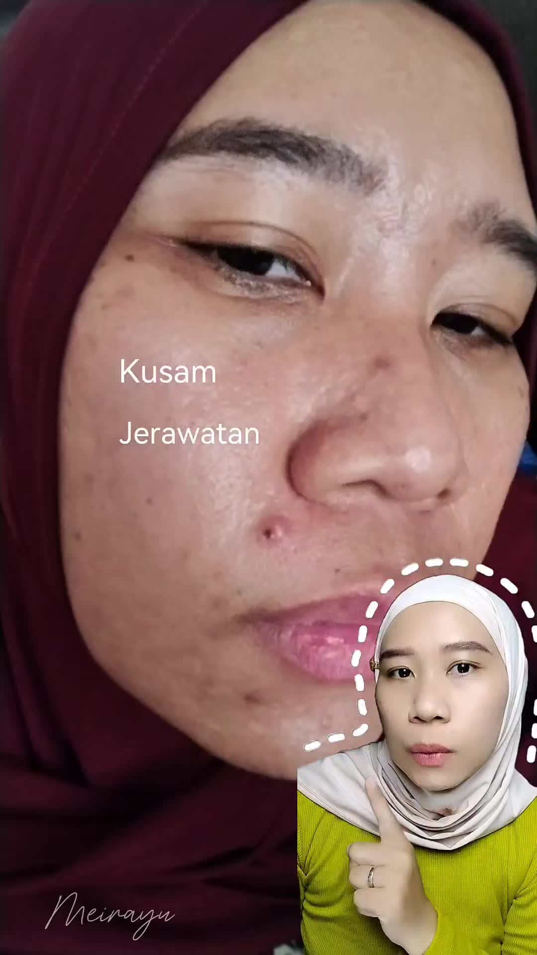 TikTok post by @meirayu2 for Kezia Beauty. Caption reads: [...] Minyak kayak kilang? 😭 Acne Series Kezia....